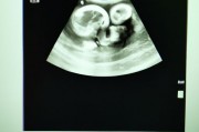 怀孕20周真实胎儿图（怀孕20周真实胎儿图片）