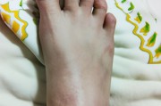 手足口病初期症状图片（手足口病初期症状图片及治疗法）